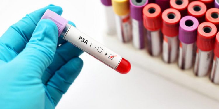 Aprueban una nueva terapia contra el cáncer de próstata