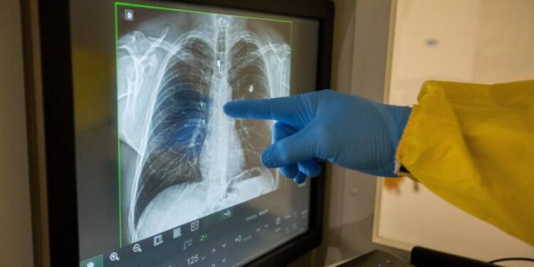 Coronavirus: secuelas que podrían aparecer en los pacientes recuperados