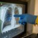 Coronavirus: secuelas que podrían aparecer en los pacientes recuperados