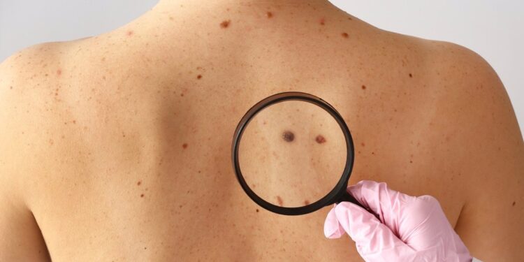 Lanús: realizarán chequeos gratuitos de lunares para detectar cáncer de piel
