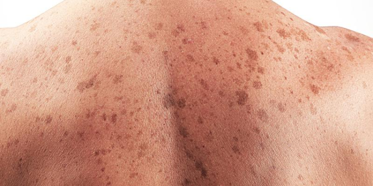 Alarma: en 2021 hubo 126 mil casos de cáncer de piel