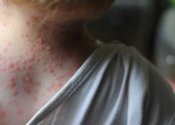 Primer caso sospechoso de viruela del mono en Argentina: ¿cuáles son los síntomas?