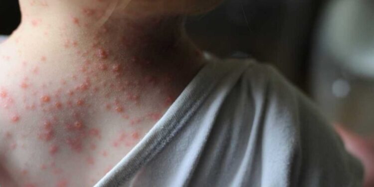 Primer caso sospechoso de viruela del mono en Argentina: ¿cuáles son los síntomas?