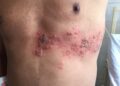 Qué es, cómo se trata y qué consecuencias puede traer la culebrilla o Herpes Zóster