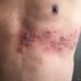 Qué es, cómo se trata y qué consecuencias puede traer la culebrilla o Herpes Zóster