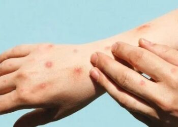 Viruela del mono: Provincia refuerza controles ante dos casos en el conurbano