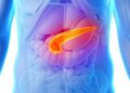Día del Síndrome de Quilomicronemia Familiar: cómo prevenir la enfermedad poco frecuente que causa pancreatitis