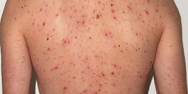 Alerta máxima en la Provincia por el brote de sarampión con la confirmación de más casos