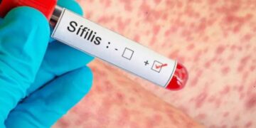 Argentina registra un pico de casos de sífilis: qué es la infección y cómo prevenirla